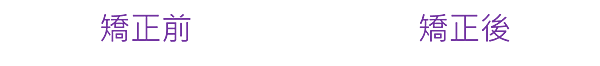 矯正前矯正後 矯正前矯正後