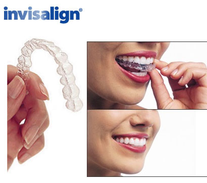 pic_invisalign.jpg pic_invisalign.jpg