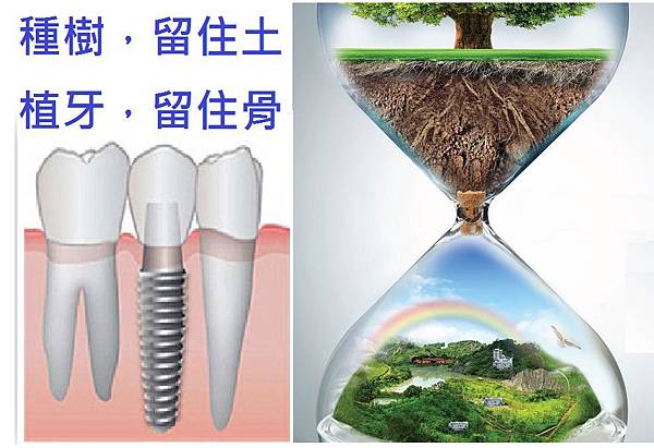 種樹 留住土 植牙 留住骨.jpg