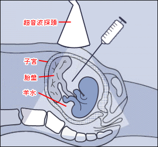 羊膜穿刺