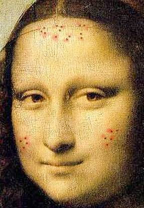 Mona_Lisa_acne_C