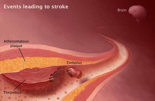 embolus3.jpg