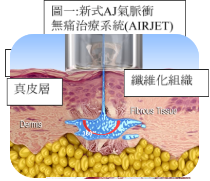 AJ氣脈衝