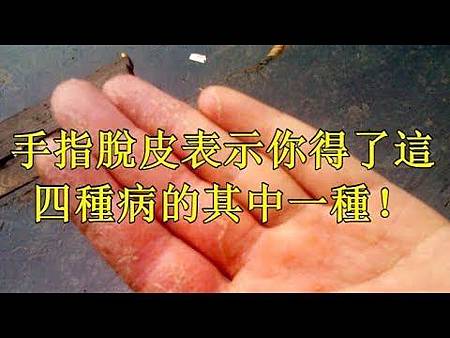 手指脫皮表示你得了這四種病的其中一種!.jpg 手指脫皮表示你得了這四種病的其中一種!.jpg