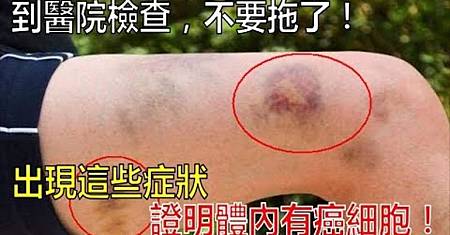 體內有癌，手腳先知，專家提醒：手腳若出現4種變化，不要拖.jpg