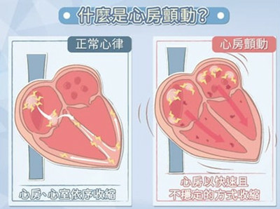 「心房顫動」增加五倍中風機會.jpg