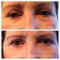 70yrs old mom-eyes 20150124