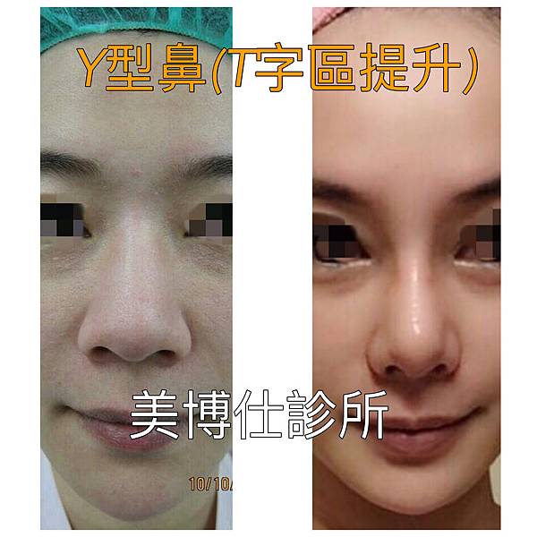 妳的國產臉條件能做Y型鼻（Y字眉心）嗎？和y鼻根有何不同？A