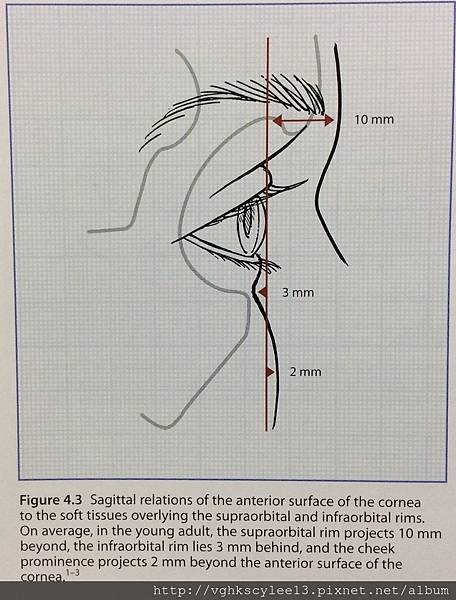 妳的國產臉條件能做Y型鼻(Y字眉心)嗎?和y鼻根有何不同?A