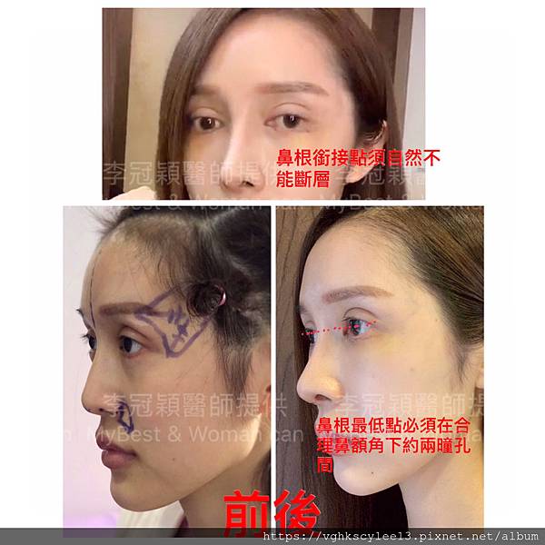 妳的國產臉條件能做Y型鼻（Y字眉心）嗎？和y鼻根有何不同？A