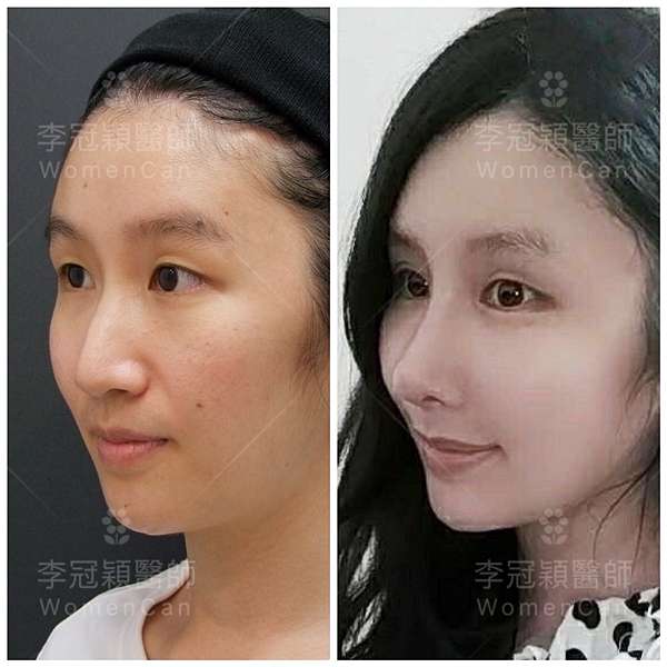俏鼻不是鼻翹 翹鼻的概念不完全適合皮厚牙暴的東方人 鼻額弧線會是另一個貼近東方特性的鼻線條美學的展現 如何避免ㄧ個限制山根高度的翹鼻或朝天鼻 美博仕診所衛教說明 俏鼻不是鼻翹 翹鼻的概念不完全適合皮厚牙暴的東方人 鼻額弧線會是另一個貼近東方特性的鼻線條美學的展現 如何避免ㄧ個限制山根高度的翹鼻或朝天鼻 美博仕診所衛教說明
