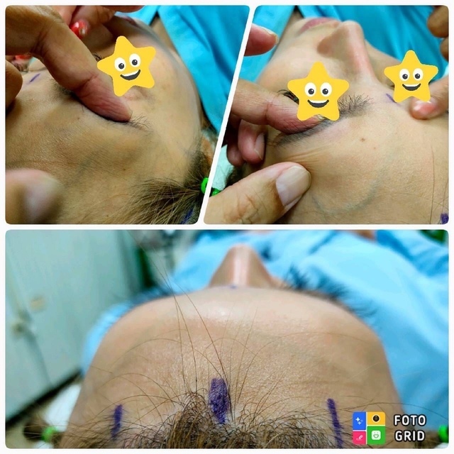 418E9B80-4C5D-4A12-8BAF-11ADA316D9C7.JPG - 墊額頭