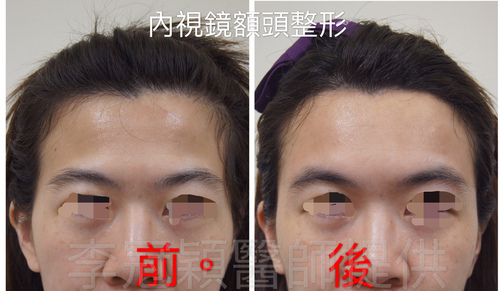 C18D0B47-0996-4FD7-9490-8346B4EEF236.jpeg - 太陽穴