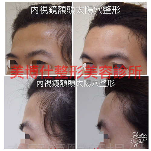 IMG_1154.JPG - 墊額頭