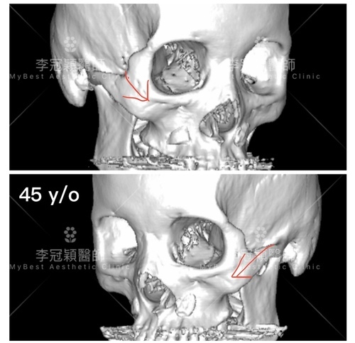 年輕型淚溝和貓咪紋跟老化三八紋有何不同?治療完全不同!