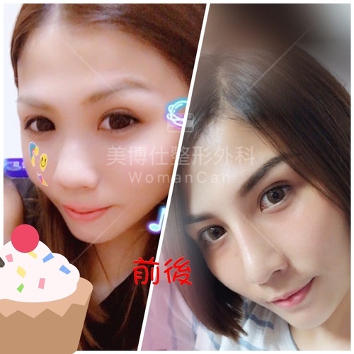 搶救隆鼻失敗(一)(二次重修鼻):隆鼻後反而要蓋劉海為什麼? IMG_2858.JPG - 鼻整形