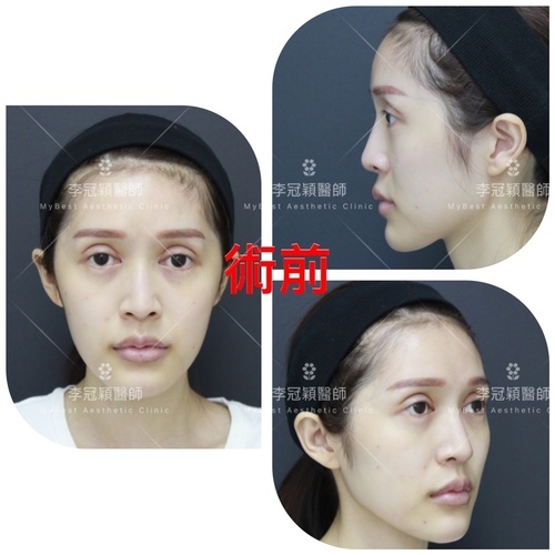 搶救隆鼻失敗(一)(二次重修鼻):隆鼻後反而要蓋劉海為什麼? IMG_0420 2.JPG - 鼻整形