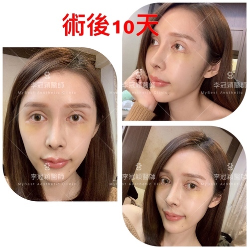 搶救隆鼻失敗(一)(二次重修鼻):隆鼻後反而要蓋劉海為什麼? IMG_0421 2.JPG - 鼻整形