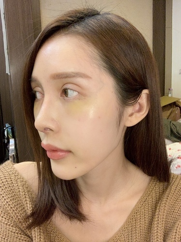 搶救隆鼻失敗(一)(二次重修鼻):隆鼻後反而要蓋劉海為什麼? IMG_0404.JPG - 鼻整形