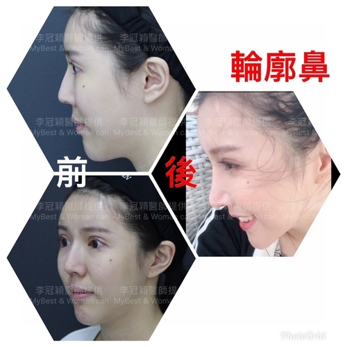 搶救隆鼻失敗(一)(二次重修鼻):隆鼻後反而要蓋劉海為什麼? IMG_3354.JPG - 鼻整形