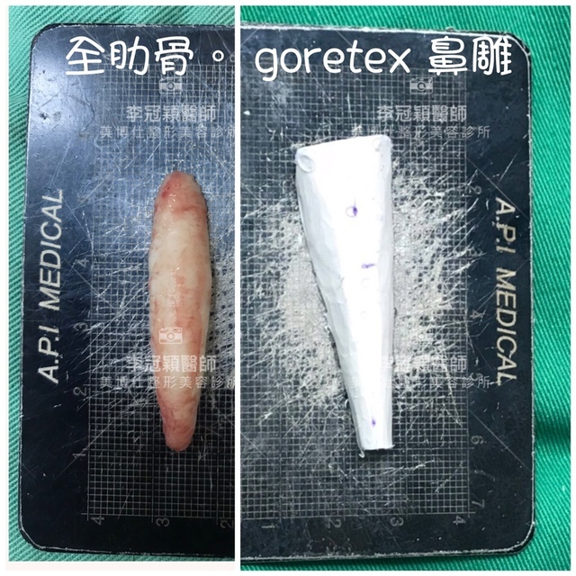 搶救隆鼻失敗(一)(二次重修鼻):隆鼻後反而要蓋劉海為什麼? IMG_0956.JPG - 鼻整形