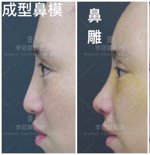 隆鼻價位多少?為什麼差異大!原因? IMG_5058.JPG - 鼻整形