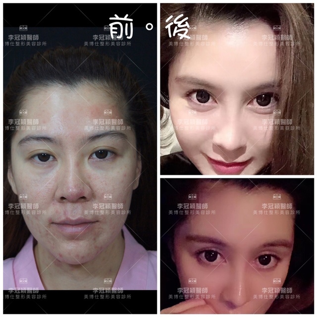 搶救隆鼻失敗(一)(二次重修鼻):隆鼻後反而要蓋劉海為什麼? IMG_9980 2.JPG - 鼻整形