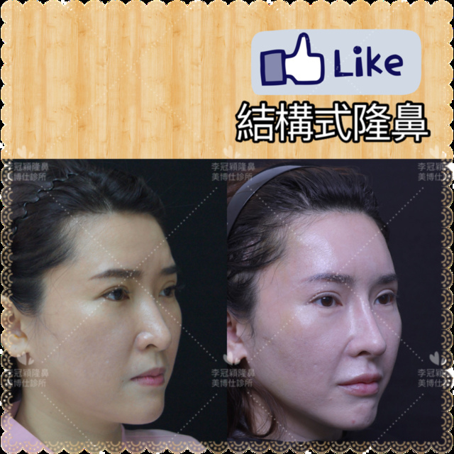 隆鼻價位多少?為什麼差異大!原因? IMG_7703 2.PNG - 鼻整形