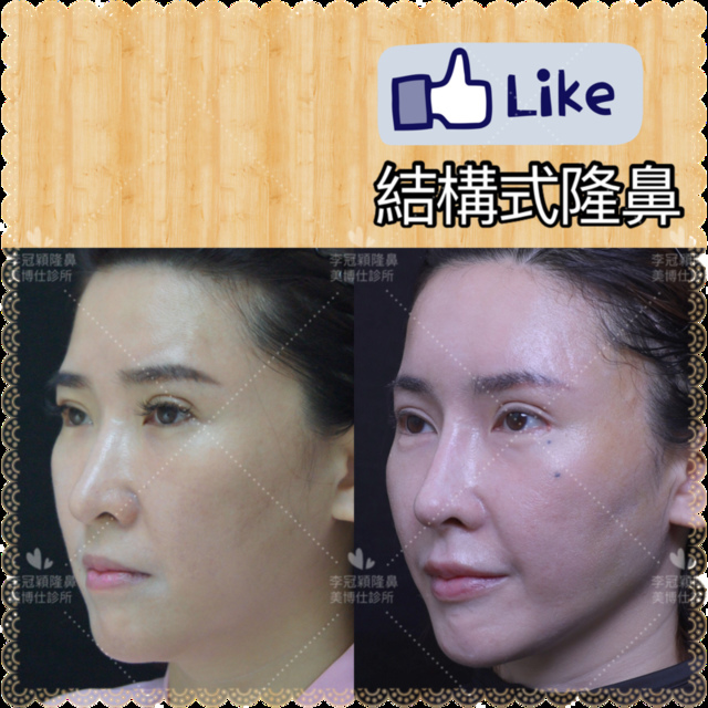 隆鼻價位多少?為什麼差異大!原因? IMG_7705 2.PNG - 鼻整形