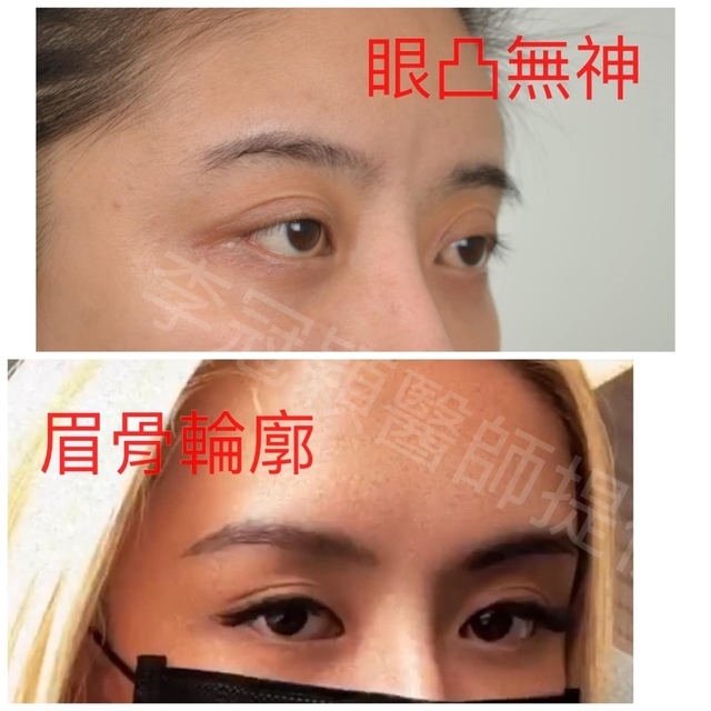 近視凸眼或眼凸怎麼辦？如何治療?