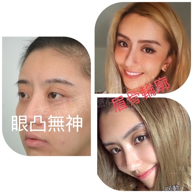 近視凸眼或眼凸怎麼辦？如何治療?