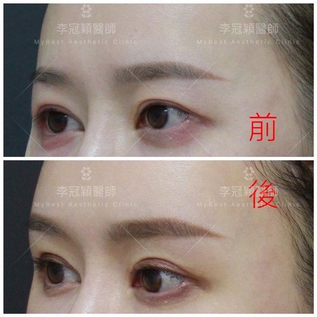 為何你有泡泡眼?凸眼有甚麼不同?只有割眼皮抽脂嗎?錯! 346CF011-E9D2-4C3D-8821-DDA2C269C072.jpeg - 墊額頭