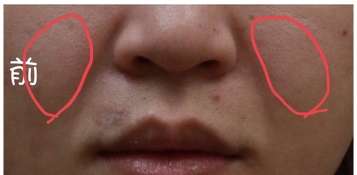 2BB2A869-EAEF-48A5-94A5-00E31CF3D422.jpg - 法令紋