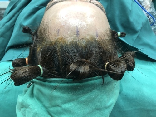 豐額／墊眉骨過渡期多久？傷口在哪裡？墊額頭會不會很腫跟瘀青？