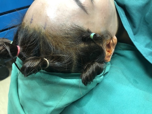 豐額／墊眉骨過渡期多久？傷口在哪裡？墊額頭會不會很腫跟瘀青？