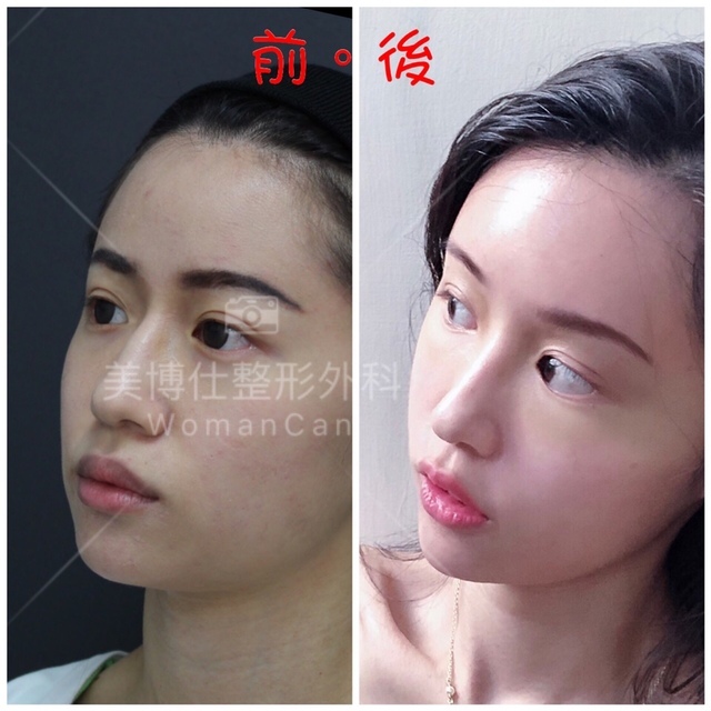 豐額／墊眉骨過渡期多久？傷口在哪裡？墊額頭會不會很腫跟瘀青？
