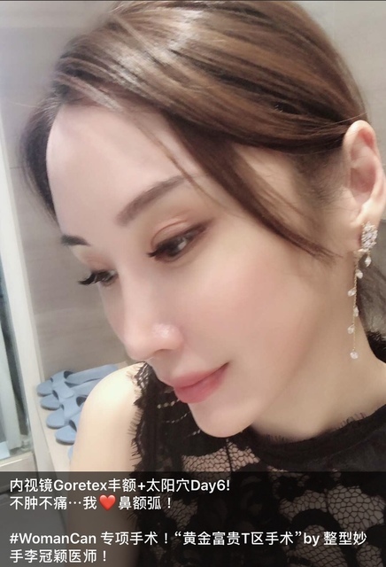 豐額／墊眉骨過渡期多久？傷口在哪裡？墊額頭會不會很腫跟瘀青？