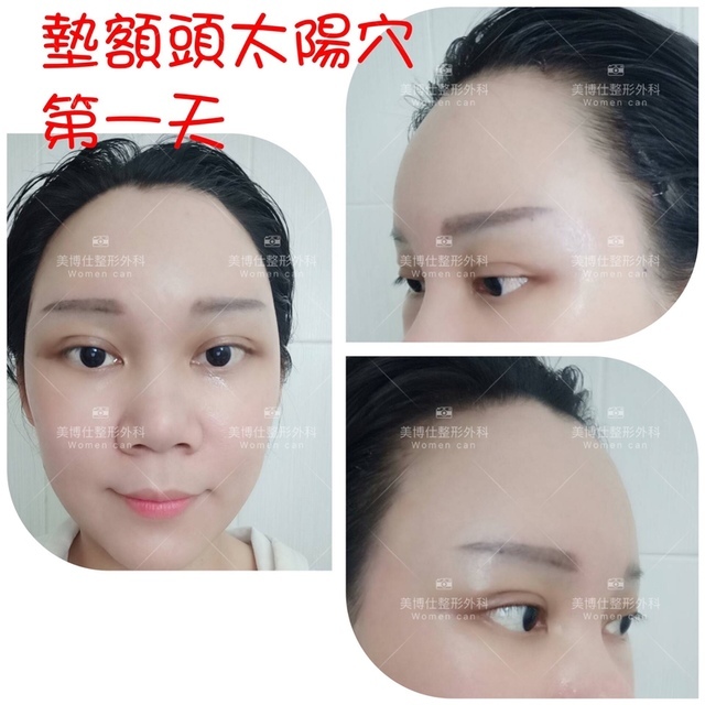 豐額／墊眉骨過渡期多久？傷口在哪裡？墊額頭會不會很腫跟瘀青？