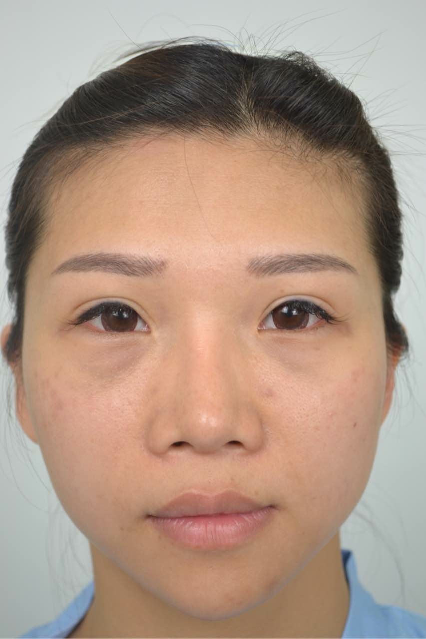 搶救隆鼻失敗(一)(二次重修鼻):隆鼻後反而要蓋劉海為什麼? 搶救隆鼻失敗(一)(二次重修鼻):隆鼻後反而要蓋劉海為什麼?