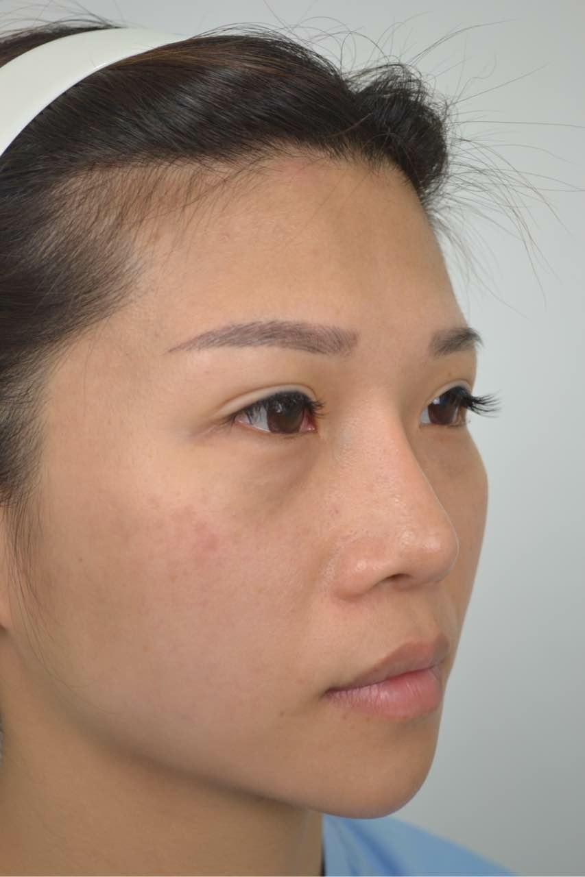 搶救隆鼻失敗(一)(二次重修鼻):隆鼻後反而要蓋劉海為什麼? 搶救隆鼻失敗(一)(二次重修鼻):隆鼻後反而要蓋劉海為什麼?