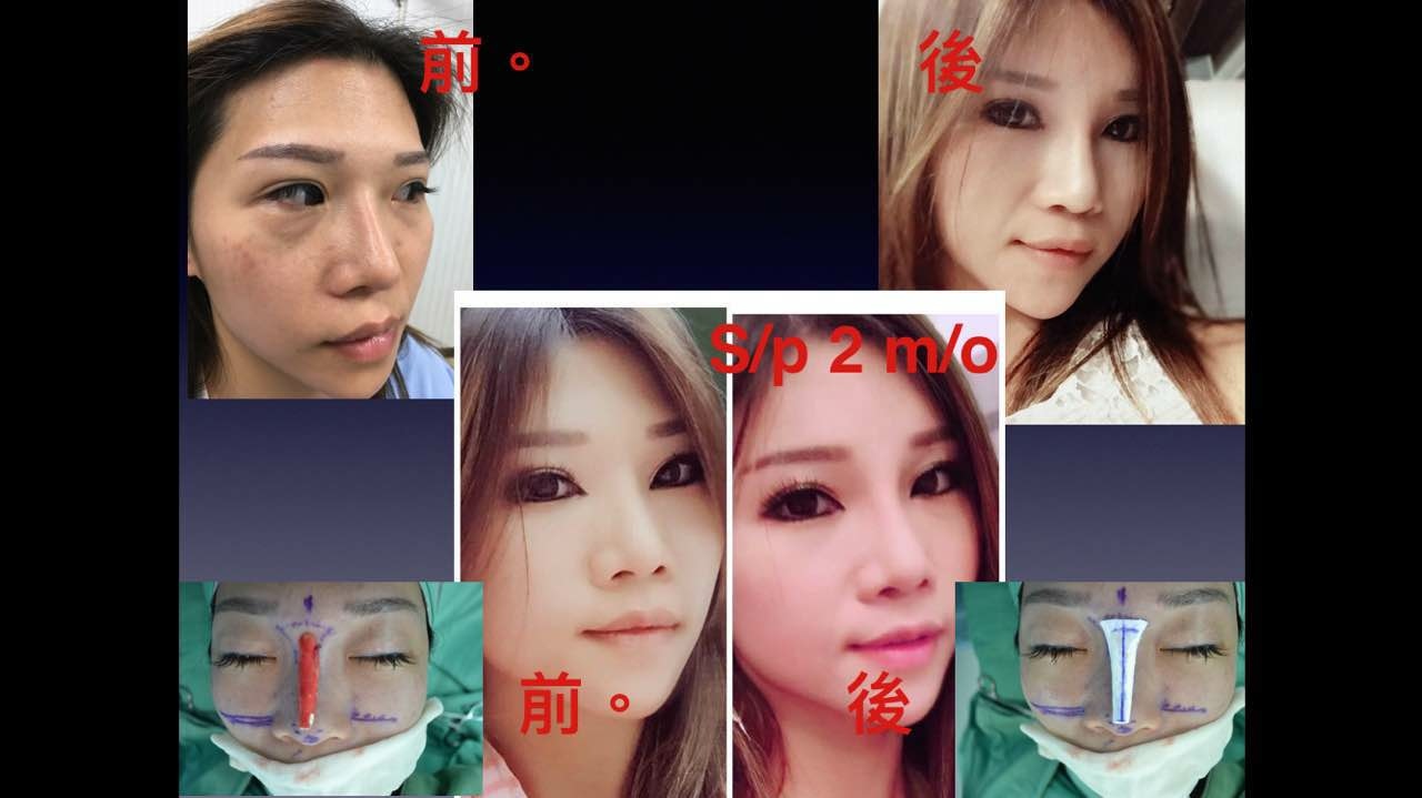 搶救隆鼻失敗(一)(二次重修鼻):隆鼻後反而要蓋劉海為什麼? 搶救隆鼻失敗(一)(二次重修鼻):隆鼻後反而要蓋劉海為什麼?