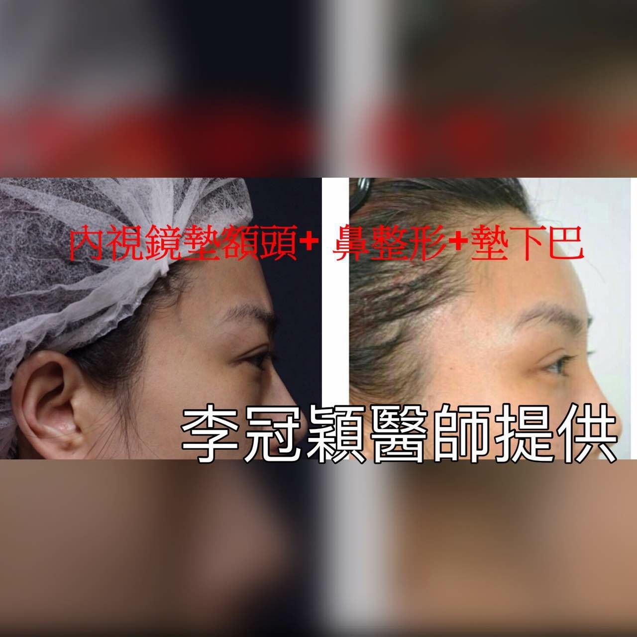 搶救隆鼻失敗（一）（二次重修鼻）：隆鼻後反而要蓋劉海為什麼?