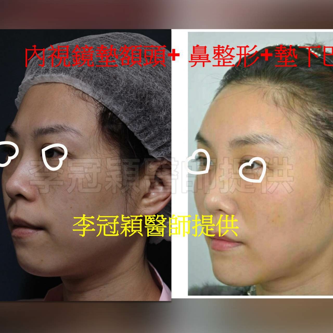 搶救隆鼻失敗(一)(二次重修鼻):隆鼻後反而要蓋劉海為什麼? 搶救隆鼻失敗(一)(二次重修鼻):隆鼻後反而要蓋劉海為什麼?