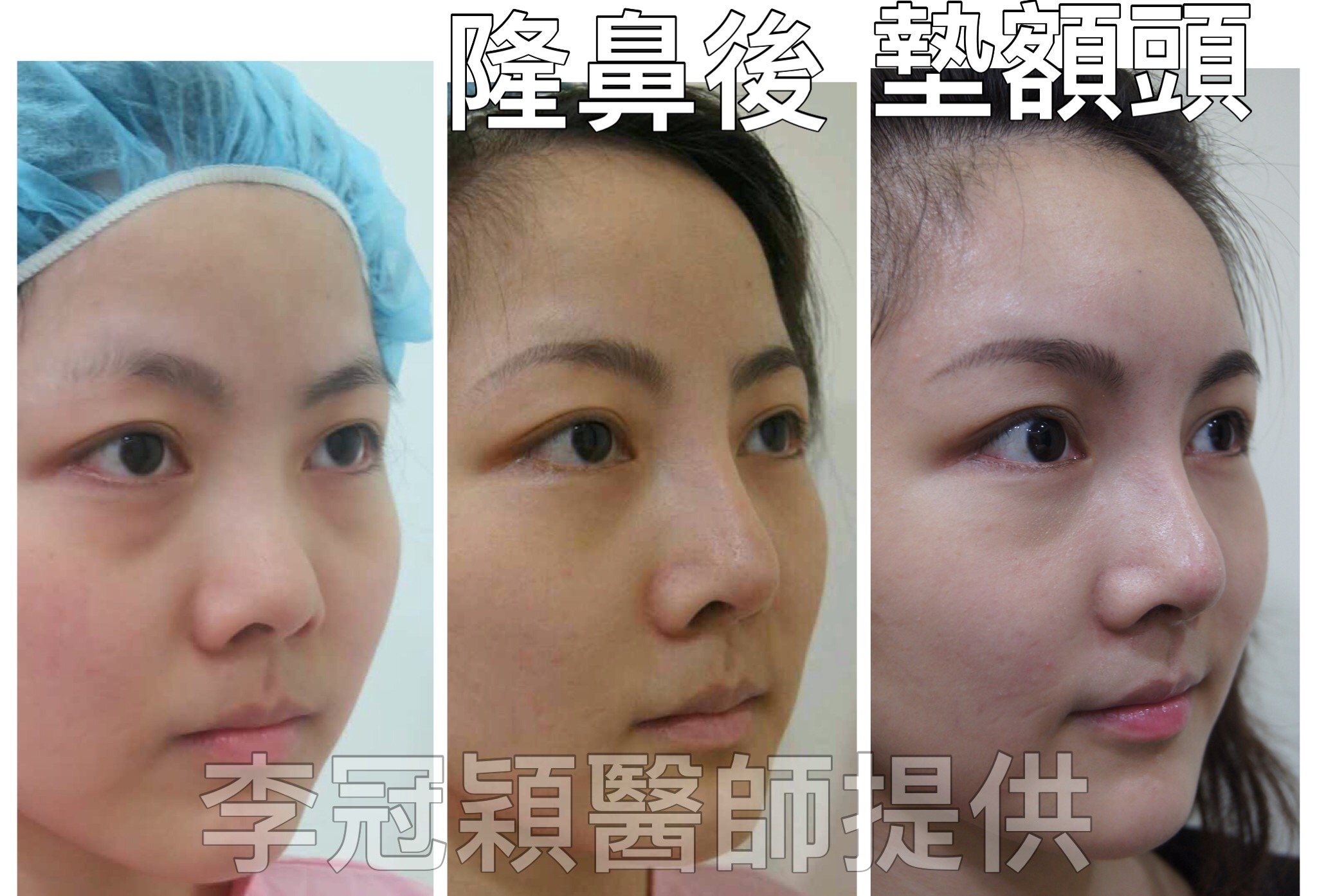 搶救隆鼻失敗(一)(二次重修鼻):隆鼻後反而要蓋劉海為什麼? 搶救隆鼻失敗(一)(二次重修鼻):隆鼻後反而要蓋劉海為什麼?