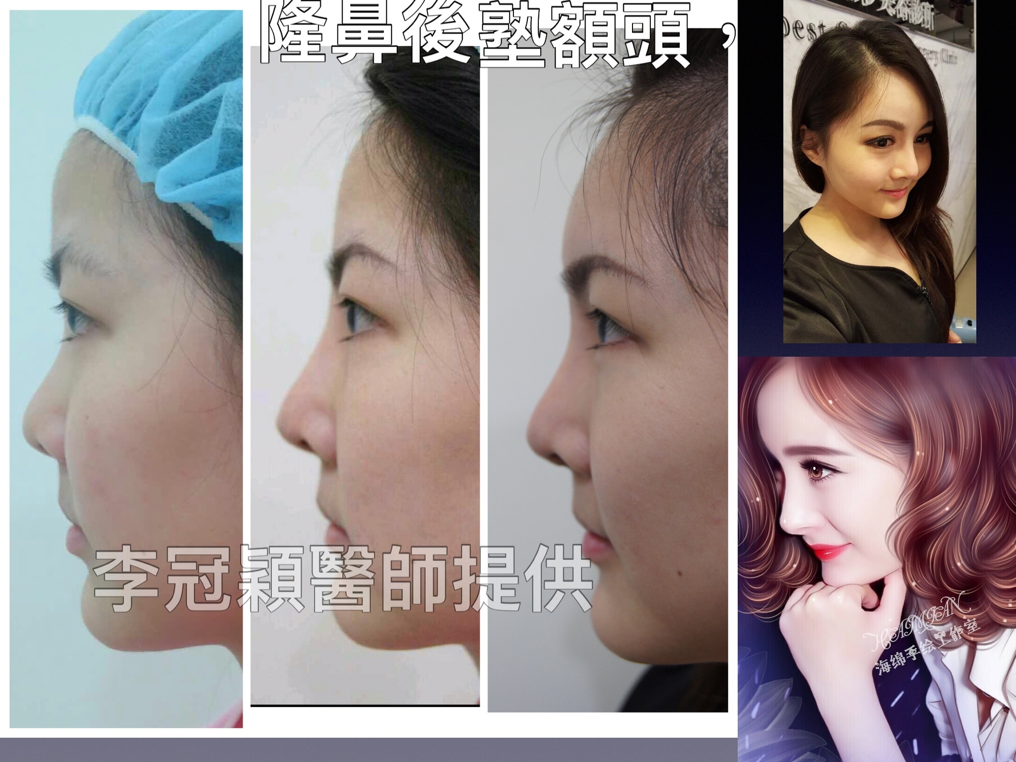 搶救隆鼻失敗(一)(二次重修鼻):隆鼻後反而要蓋劉海為什麼? 搶救隆鼻失敗(一)(二次重修鼻):隆鼻後反而要蓋劉海為什麼?