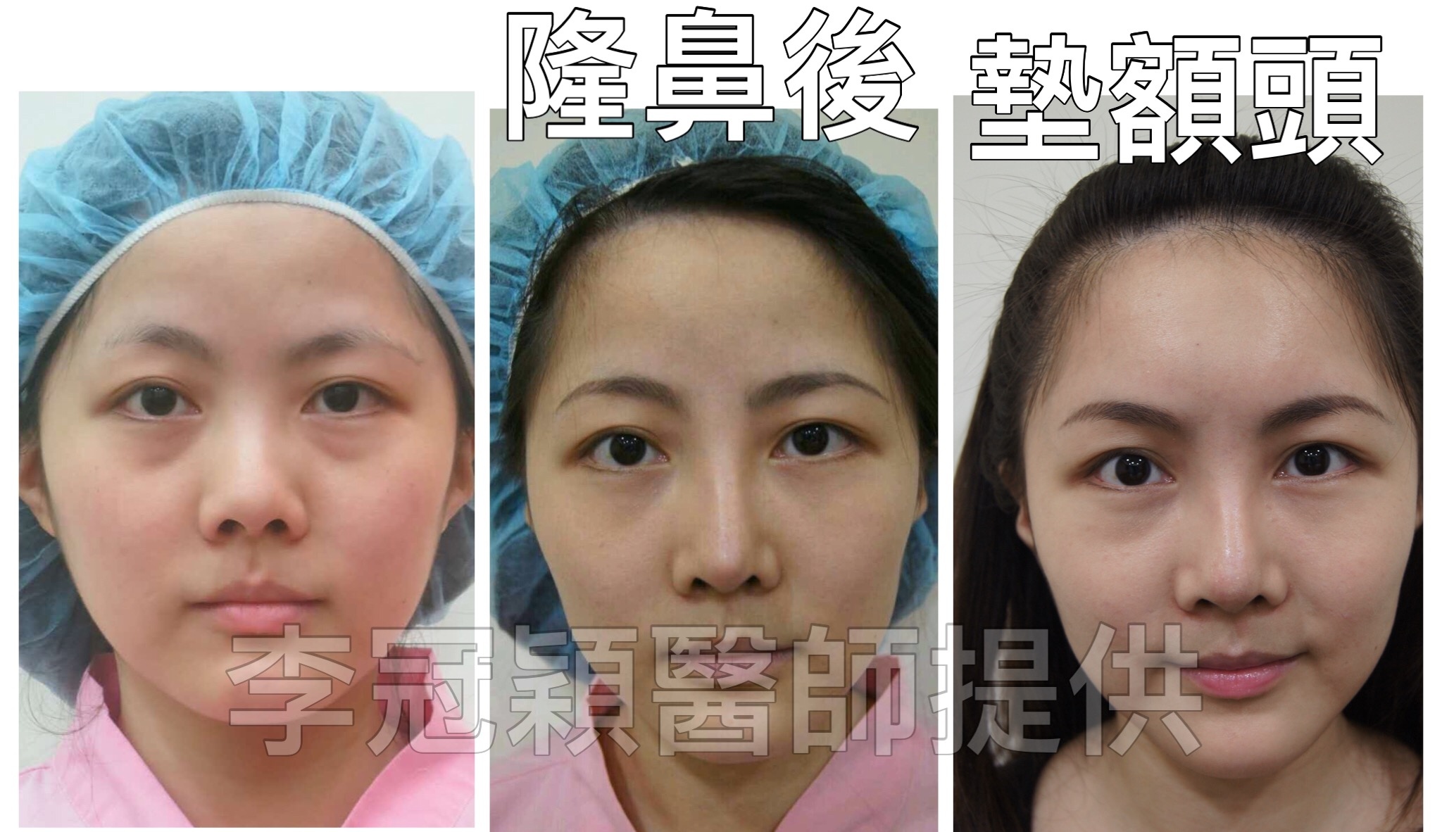 搶救隆鼻失敗(一)(二次重修鼻):隆鼻後反而要蓋劉海為什麼? 搶救隆鼻失敗(一)(二次重修鼻):隆鼻後反而要蓋劉海為什麼?