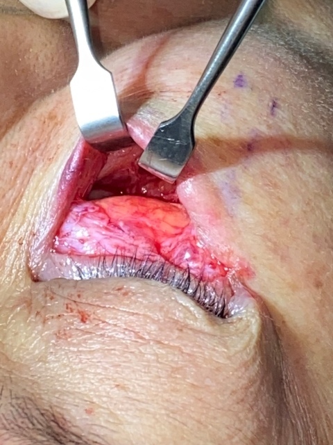 IMG_1049.JPG - 眼袋