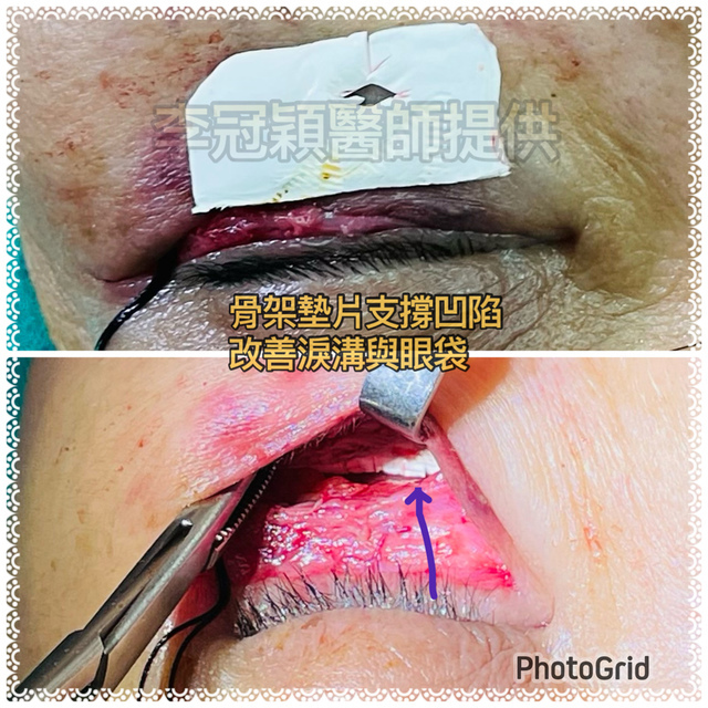 IMG_FAD1EE3BED22-1.jpeg - 蘋果肌墊片貓咪紋問題