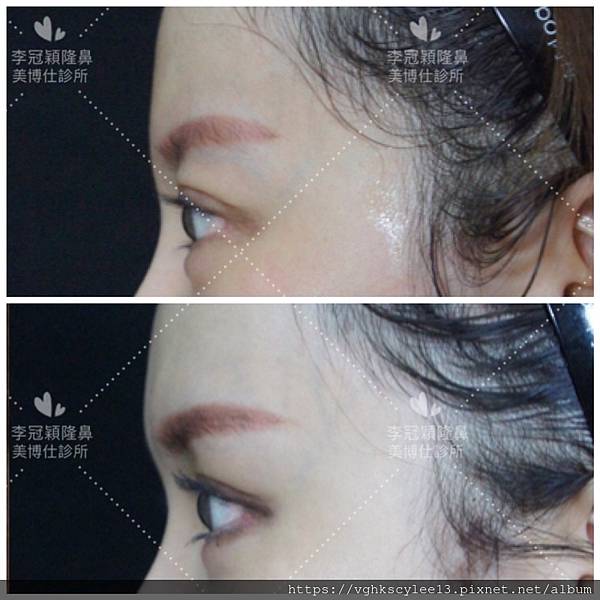 為何你有泡泡眼?凸眼有甚麼不同?只有割眼皮抽脂嗎？錯！