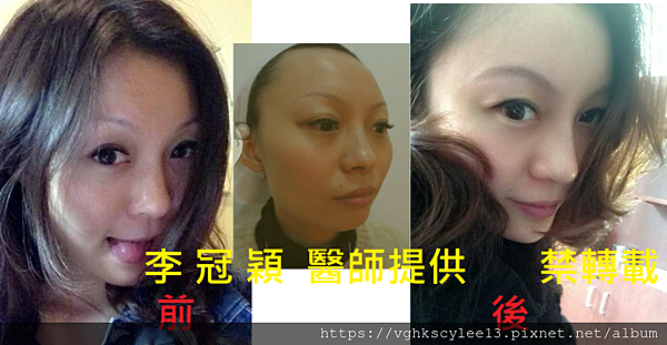 鼻 下巴 額部塑形 頻果肌.jpg 鼻 下巴 額部塑形 頻果肌.jpg